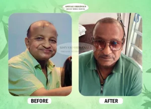Before After Result of Our Adivasi Hair Oil 1
