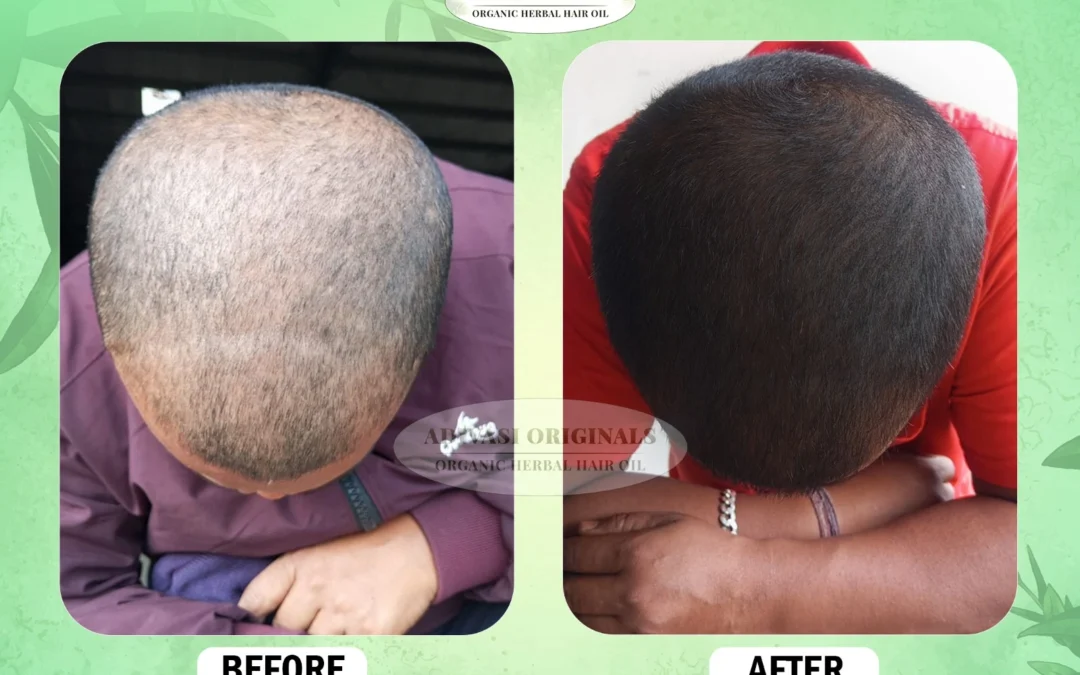 Is Adivasi Hair Oil Good for Hair Growth? Benefits, Ingredients & Results