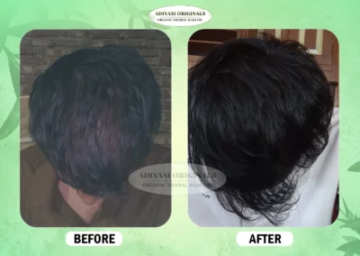 Before After Result of Our Adivasi Hair Oil 4
