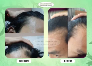 Before After Result of Our Adivasi Hair Oil 5