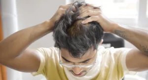 man Stressed because of hair fall and dandruff